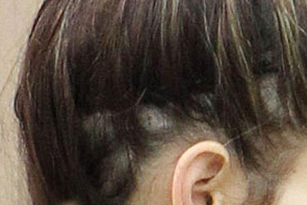 Рост волос выше уха