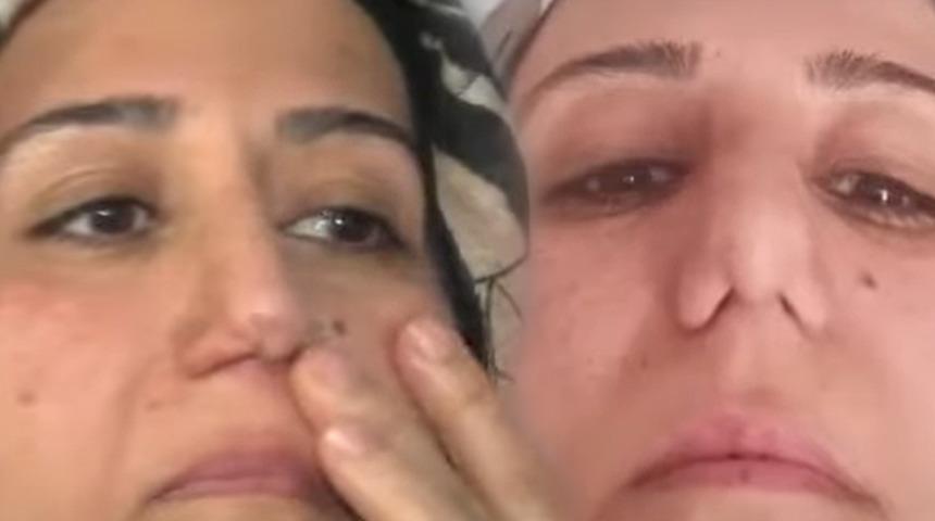 Böylesi görülmedi! Burun estetiği yaptırmak istedi, şok üstüne şok yaşadı: 'Bir yere gidince millet bana bakıyor'