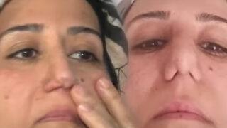 Böylesi görülmedi! Burun estetiği yaptırmak istedi, şok üstüne şok yaşadı: 'Bir yere gidince millet bana bakıyor'