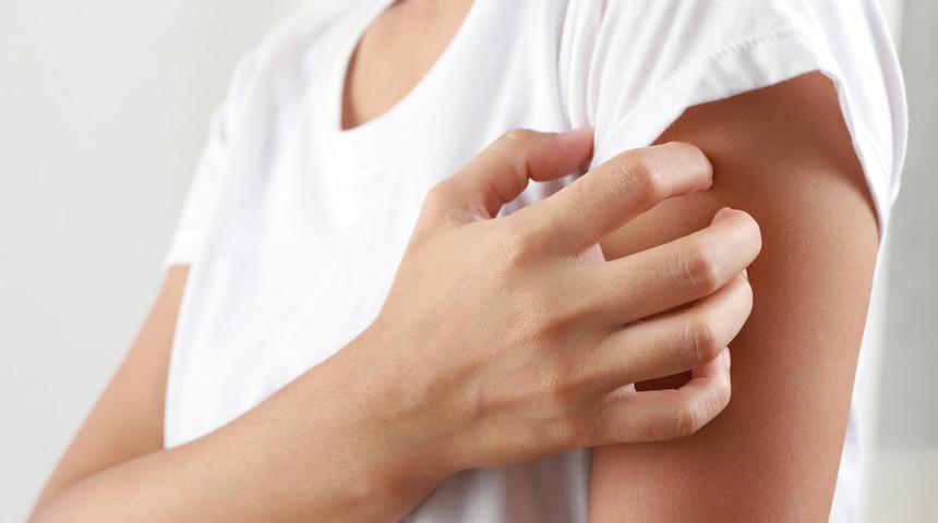 Kurdeşene ne iyi gelir, nasıl geçer? Kurdeşene sirke iyi gelir mi, bitkisel çözümler nelerdir?