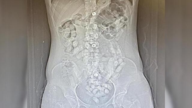 Erzincan'da iki kadının midesinden 693,3 gram Afyon sakızı çıktı