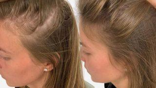 Tek malzemeyle saç dökülmesini anında kesiyor! Dökülen saçları geri çıkartıyor