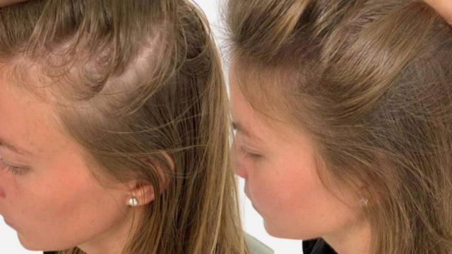 Tek malzemeyle saç dökülmesini anında kesiyor! Dökülen saçları geri çıkartıyor