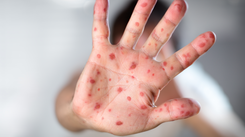 Salgın kızamık hastalığına dikkat! Vakalar giderek artıyor... "Bir an önce ciddi tedbirler alınmalı!"