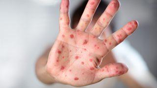 Salgın kızamık hastalığına dikkat! Vakalar giderek artıyor... Bir an önce ciddi tedbirler alınmalı!