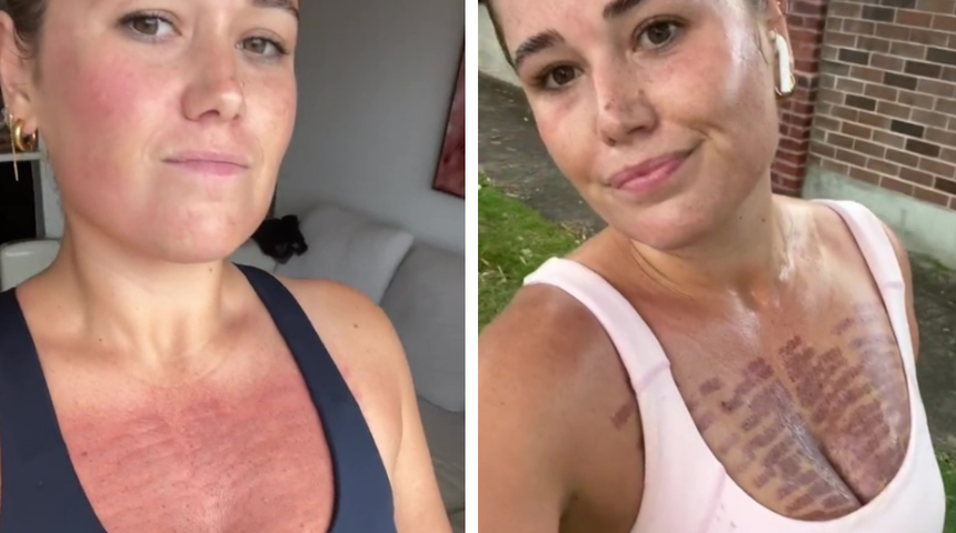 Göğsüne yaptırdığı lazer yüzünden cildi yandı! Lazer yanıklarını paylaşarak işlemin risklerini gösterdi