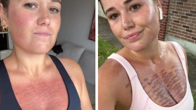 Göğsüne yaptırdığı lazer yüzünden cildi yandı! Lazer yanıklarını paylaşarak işlemin risklerini gösterdi