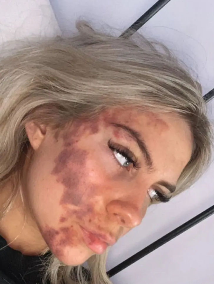 Her şey bir sivilceyle başladı! Ardından morluklar bütün vücuduna yayıldı... Doktorlar bile duruma şaşkın G1