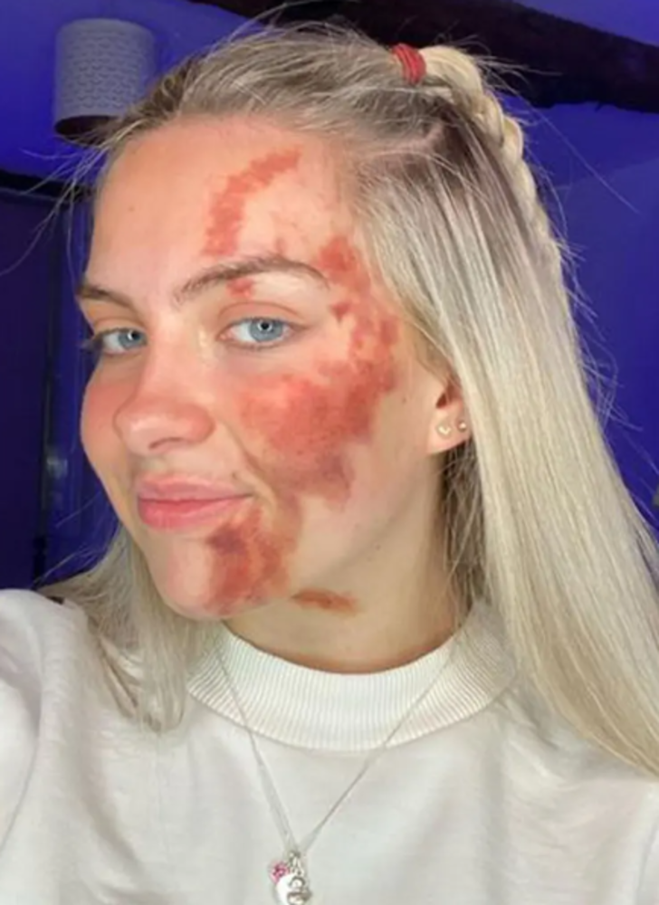 Her şey bir sivilceyle başladı! Ardından morluklar bütün vücuduna yayıldı... Doktorlar bile duruma şaşkın G2