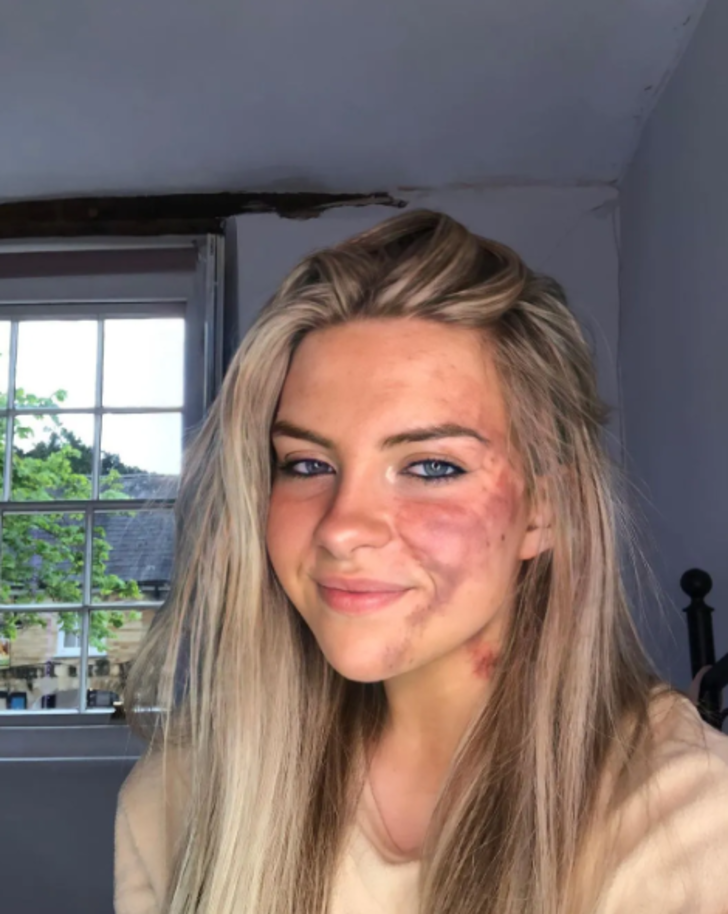 Her şey bir sivilceyle başladı! Ardından morluklar bütün vücuduna yayıldı... Doktorlar bile duruma şaşkın G3