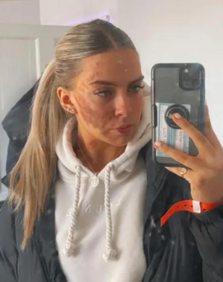 Her şey bir sivilceyle başladı! Ardından morluklar bütün vücuduna yayıldı... Doktorlar bile duruma şaşkın G4