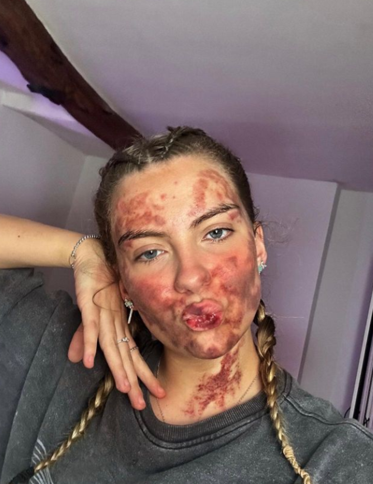 Her şey bir sivilceyle başladı! Ardından morluklar bütün vücuduna yayıldı... Doktorlar bile duruma şaşkın G5