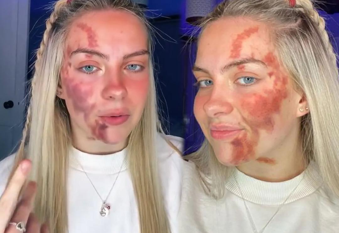 Her şey bir sivilceyle başladı! Ardından morluklar b&uuml;t&uuml;n v&uuml;cuduna yayıldı... Doktorlar bile duruma şaşkın