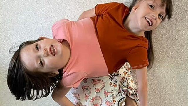 Doktorların yaşamaz dediği yapışık ikizler hayata tutundu! Tek bedende iki farklı karakter