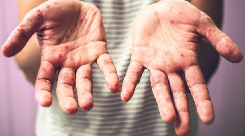 Çocuğunuz el, ayak hastalığına yakalanırsa?