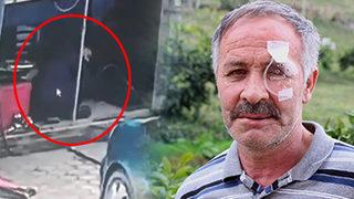 Hayatının şokunu yaşadı! Az kalsın canından oluyordu... 12 gün yoğun bakımda kaldı, bir gözünü kaybetti