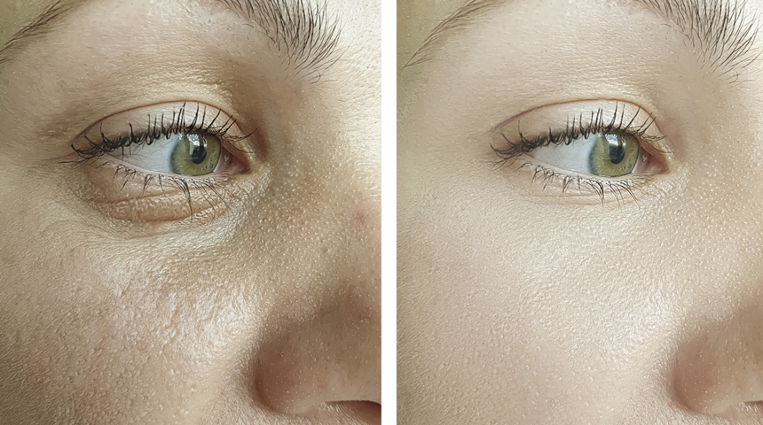 Güzellik uzmanının kırışıklıkları silip süpüren yaşlanma karşıtı bakımı! Bu doğal yağ botoks etkisi yaratıyor