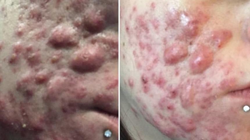 Binlerce kişi sivilceleri için takip ediyor!