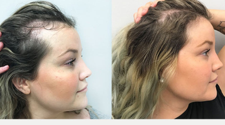 Şampuana eklenen tek malzeme adeta saç fışkırtıyor! Saç dökülmesini anında durduran ve uzatan çözüm