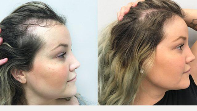 Şampuana eklenen tek malzeme adeta saç fışkırtıyor! Saç dökülmesini anında durduran ve uzatan çözüm