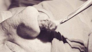 Nefes almakta zorlanıyorum dedi! Burnundan çıkanlar şaşkına çevirdi: 8 santimetre...