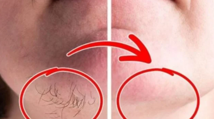 İstenmeyen tüylerden kurtulmanızı sağlayacak doğal çözüm! Lazer epilasyona gerek kalmadı