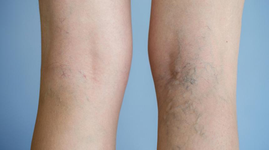 Varise ne iyi gelir, varis olmaması için ne yapılmalı? Evde varis tedavisi nasıl yapılır, zeytinyağı varise iyi gelir mi?