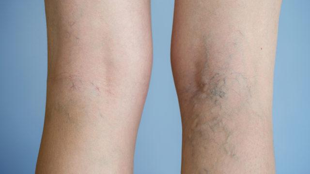 Varise ne iyi gelir, varis olmaması için ne yapılmalı? Evde varis tedavisi nasıl yapılır, zeytinyağı varise iyi gelir mi?