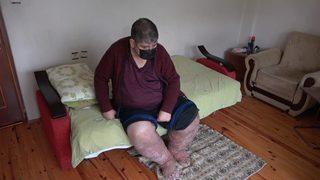 Bir sivrisinek ısırığı hayatını kararttı: 9 yıldır insan içine çıkamıyor! Tedavi edilmezse...