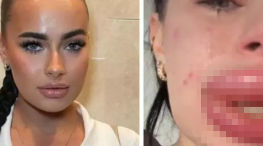 Ücretsiz diye yaptırdı kabusu yaşadı! Dudak dolgusu yüzünden başına gelenleri ağlayarak anlattı