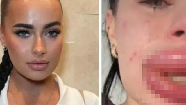 Ücretsiz diye yaptırdı kabusu yaşadı! Dudak dolgusu yüzünden başına gelenleri ağlayarak anlattı