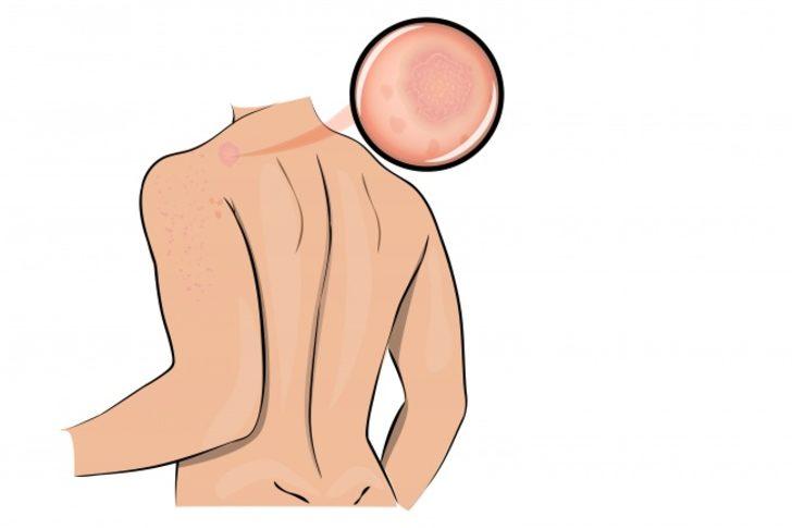 Stresin neden olduğu hastalıklar G1