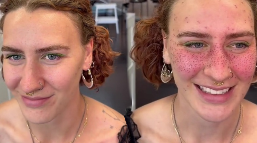 Y&uuml;z&uuml;ne yaptırdığı &ccedil;il d&ouml;vmesi TikTok'ta olay oldu! "Uyuzu varmış gibi g&ouml;r&uuml;n&uuml;yor"