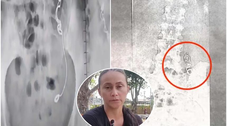 11 yıl boyunca içinde unutulan iğne ve iplikle yaşadı! “Çok büyük acılar hissettim”