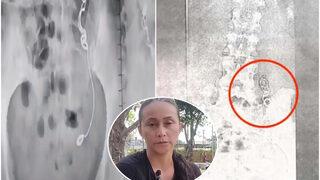 11 yıl boyunca içinde unutulan iğne ve iplikle yaşadı! “Çok büyük acılar hissettim”