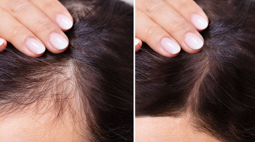 Sadece 2 malzeme ile dökülen saçlarınızı geri kazanın! Saç çıkartan maske tarifi