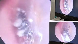 Kulak uğuldaması şikayetiyle doktora başvurdu! Kulağının içinde örümceğin yuva yaptığını öğrenince şoke oldu