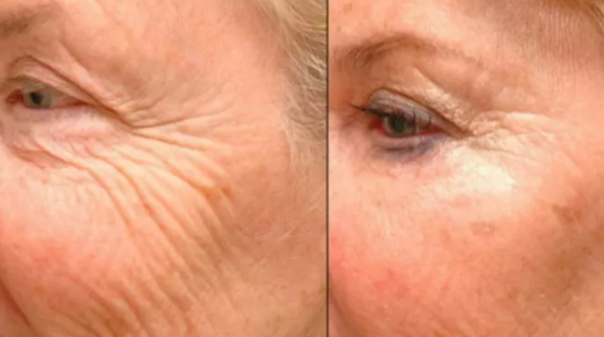 Botoks etkisi kanıtlanmış maske tarifi! Bir tutamıyla yaşlılık izlerini silip süpürüyor