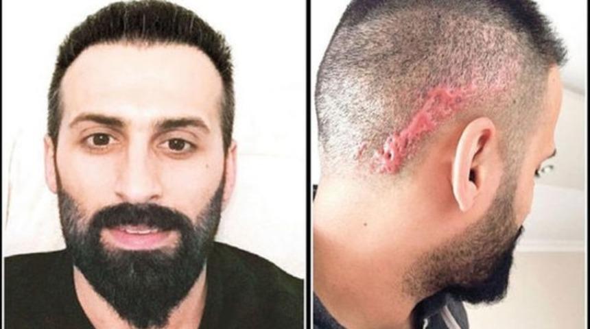 Saç ekimi istedi, kafasında keloid denilen yara izi oluştu