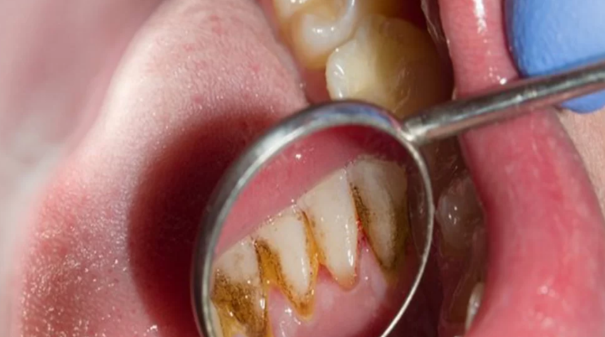 Diş tartarlarını ve taşlarını anında yok ediyor! İnci gibi parlayan dişler i&ccedil;in etkili &ccedil;&ouml;z&uuml;mler