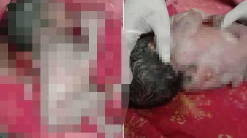 Hindistan’da sırtında üçüncü bir kolla doğan bebek şaşkına çevirdi! Halk görmek için hastaneye akın etti