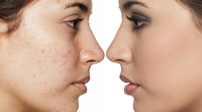 Kapatıcıyla kapanmayan sivilceleri anında yok ediyor! Pürüzsüz makyaj tüyosunu paylaştı