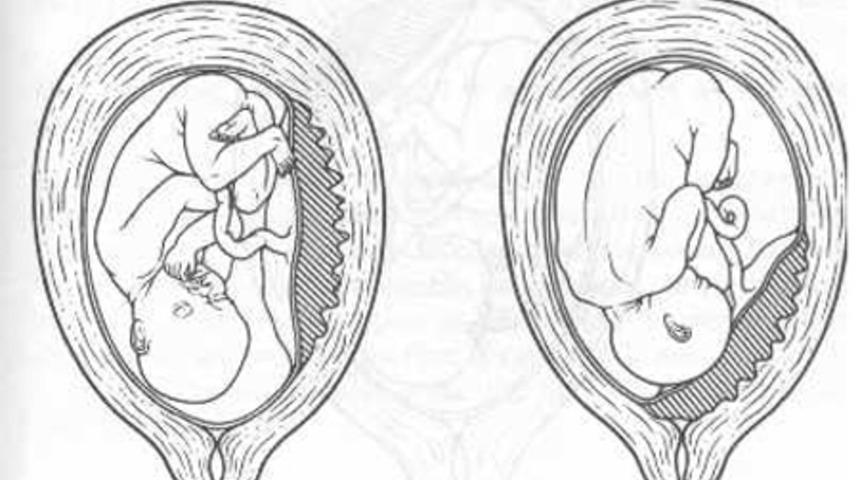 Sezaryen Olan Anneler Dikkat!