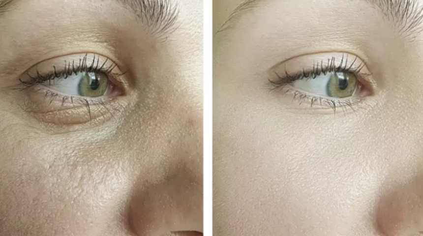 Yüzdeki kırışıklıkları bir gecede geçiriyor! Sadece üç malzemeyle hazırlanan yaşlanma karşıtı maske tarifi