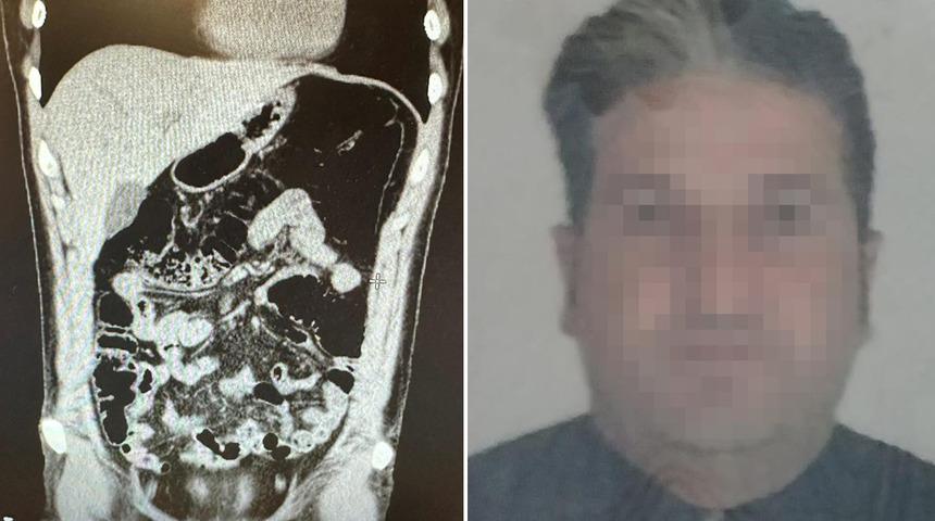 Midesinde uyuşturucuyla yakalandı, savunması şaşkına çevirdi! “Ben içici değil, yutucuyum”