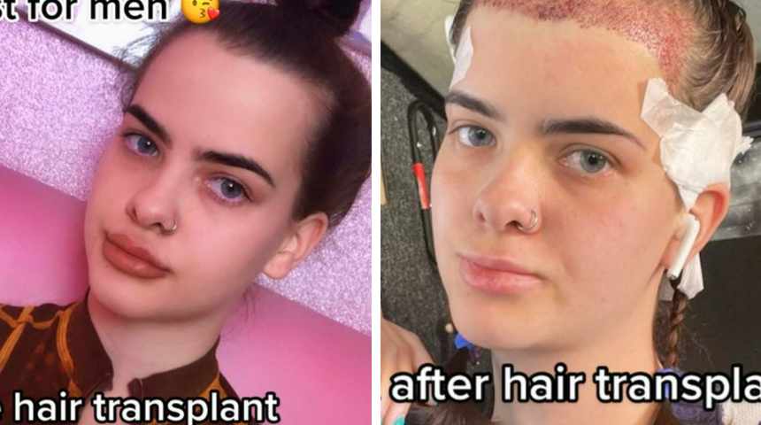 Geniş alnı yüzünden yıllarca zorbalığa uğradı! Saç ekimi yaptırarak yaşadığı değişimi gösterdi