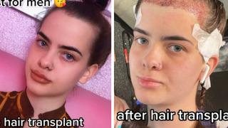 Geniş alnı yüzünden yıllarca zorbalığa uğradı! Saç ekimi yaptırarak yaşadığı değişimi gösterdi