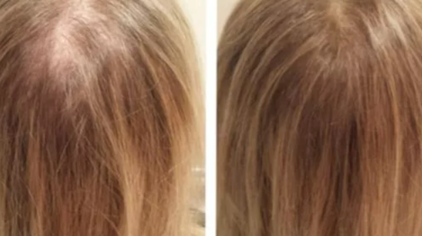 Bir damlası saç köklerini fışkırtıyor! Dökülen saçları çıkartan etkili bakım