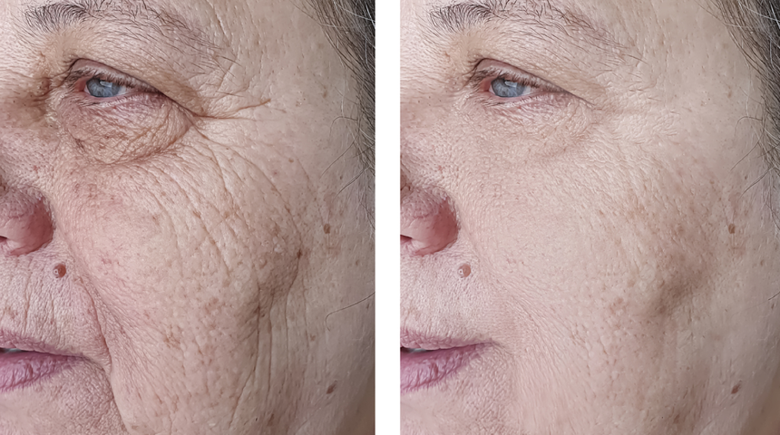 Kaz ayaklarını ve kırışıklıkları yok ederek 10 yaş gençleştiren maske tarifi