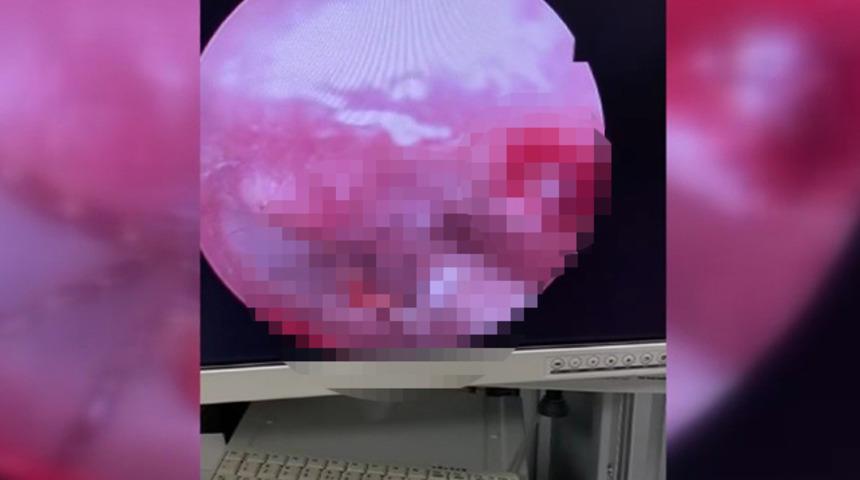 Kulak ağrısı şikayetiyle hastaneye gitti, içinden çıkan şaşkına çevirdi!